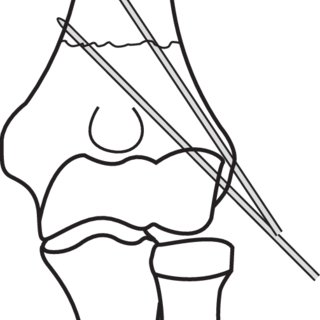 320x320 step coronal line drawing demonstrating ideal divergent lateral