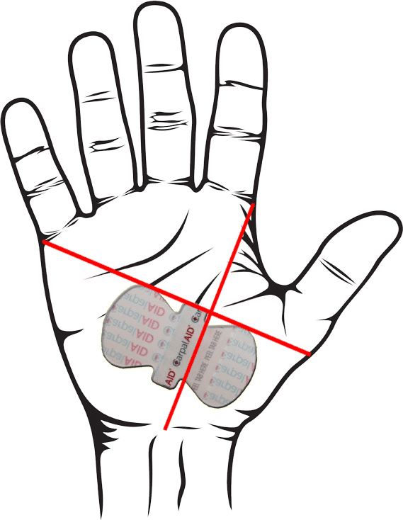 569x734 Carpal Tunnel Injury In The Workplace Carpalaid For Corporations