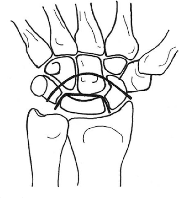 582x644 Figure From Perilunate Dislocations
