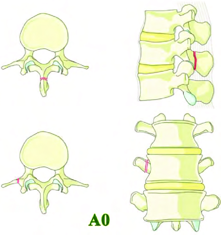 765x816 subtype a0 minor injuries injuries such as transverse process