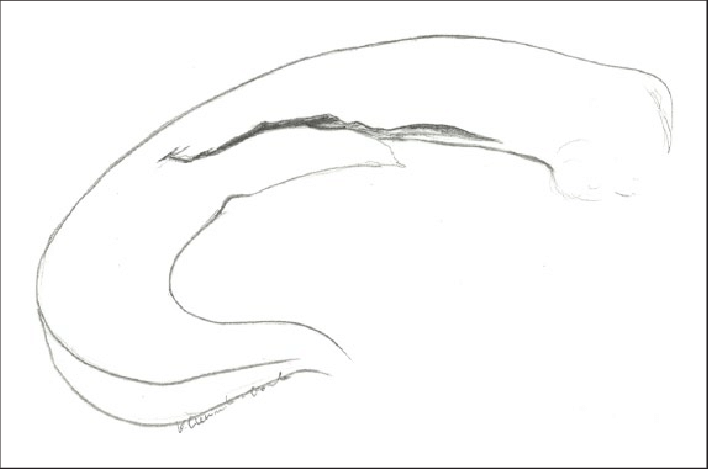 708x469 An Example Of Meniscus Injury Treated As A Part Of This Study