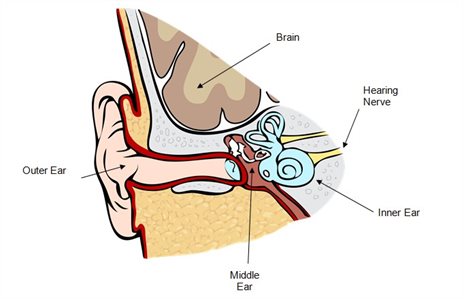 464x299 Bone Conductionmiddle Ear Implants