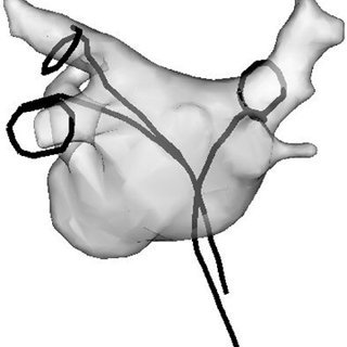 320x320 Pv Isolation Guidance System Overlay Display Showing The Helix