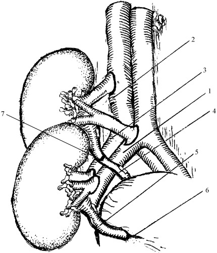 430x500 Method Of Monolateral Double Kidney Transplantation