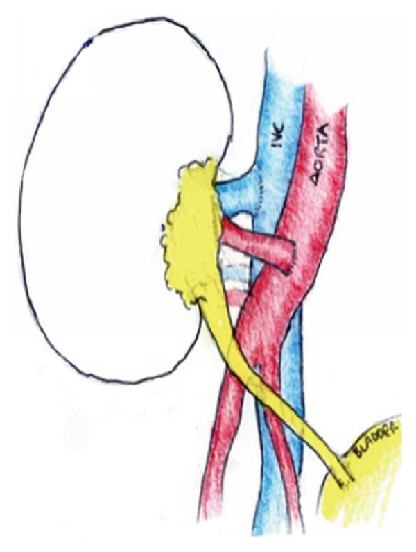 600x795 Schematic Diagram Of The Implantation Of Kidney With Vascular