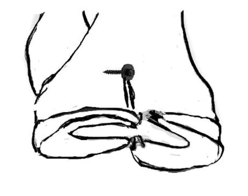 850x670 Method Of Arthroscopic Pull Out Repair Technique In A Right Knee