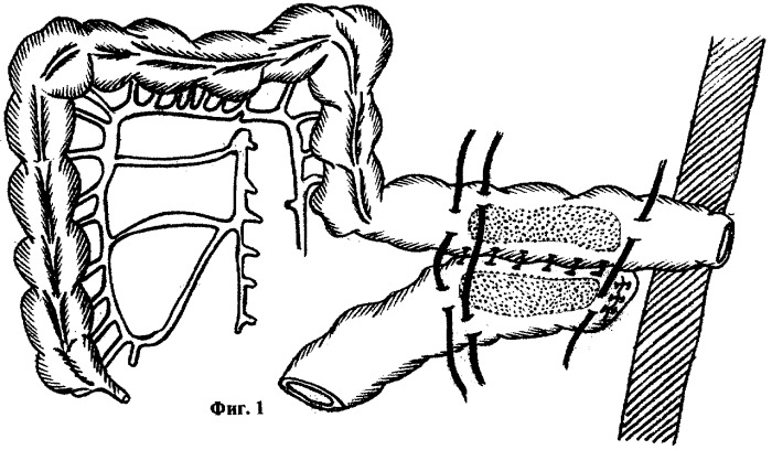 700x408 Method For Two Stage Development Of Large Intestine Large