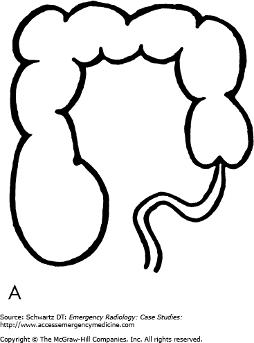 367x495 chapter ii large bowel obstruction emergency radiology case