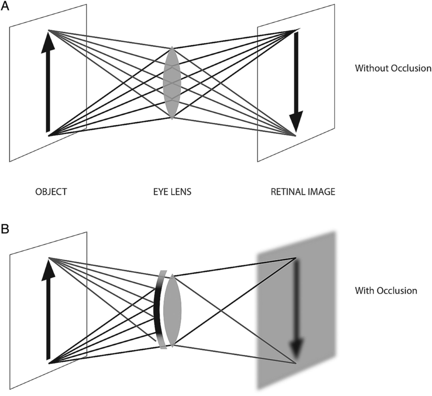 850x780 Ray Diagram Illustrating The Optical Effect Of A Contact Lens