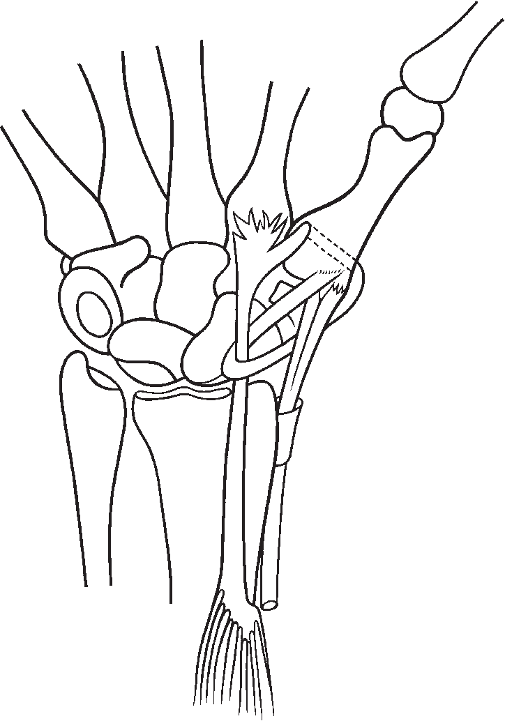 724x1034 reconstruction of thumb carpometacarpal joint