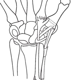 320x320 bilateral single jess