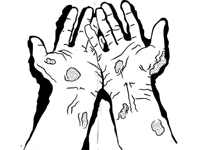 640x480 special report a leper's tale the express tribune