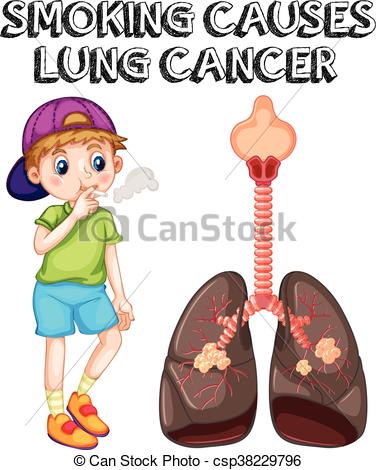 376x470 Boy Smoking Cigarette And Lung Cancer Illustration