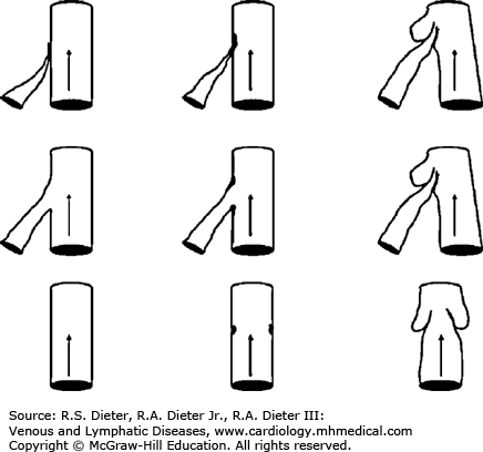 436x408 Lymphatic Biology And Pathobiology Venous And Lymphatic Diseases