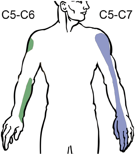 432x492 Zone Of Loss Of Protective Sensation After An Upper Type Lesion