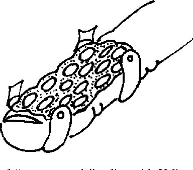 384x338 Long Term Results Of Splintage For Mallet Finger