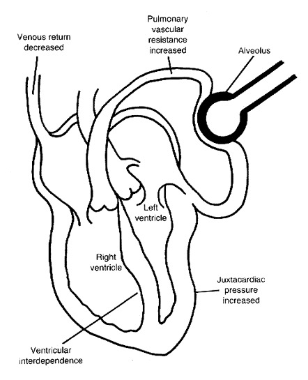 442x545 Mechanical Ventilation Nejm