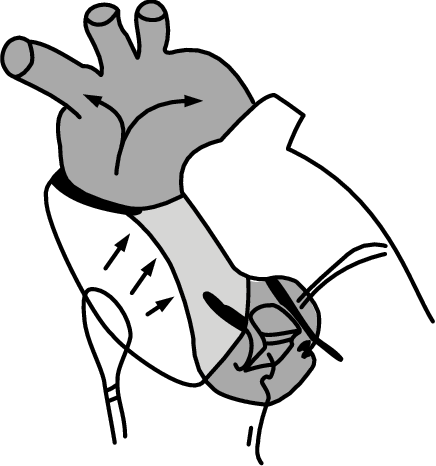 436x466 The Use Of Intra Aortic Baloon Counterpulsation, Kantrowitz Cardio
