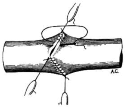 416x355 drawing of blood vessel suture method done