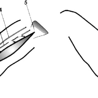 320x320 Schematic Drawing Of The Technique Of The Transfer Of The Gracilis