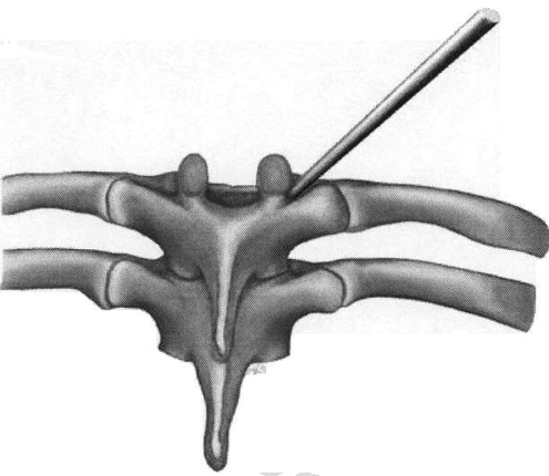 495x430 A To Drawing Of The Extrapedicular Placement Of The Biopsy