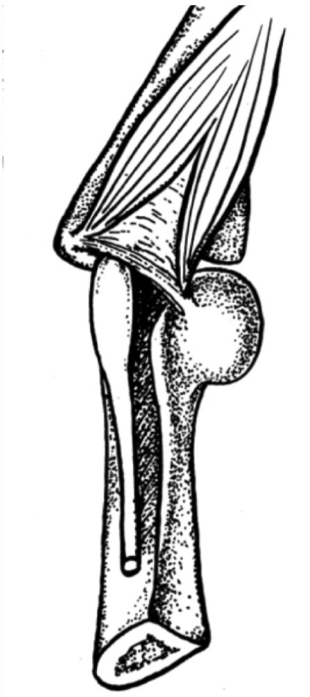 445x1000 Drawing Of Osborne's Ligamentnote The Entrapment Site A Open I