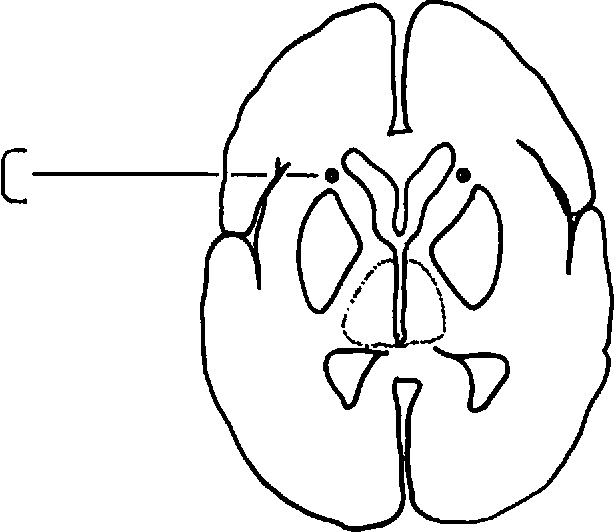 614x532 Figure From Neurosurgery For Mental Disorders