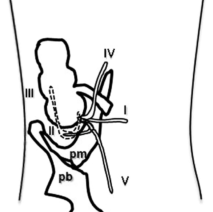 723x719 Schematic Drawing Of Normal Appendiceal Position Type I