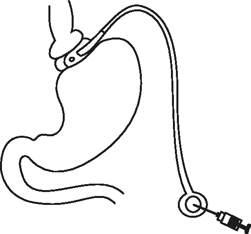 508x474 figure from surgical treatment of obesity an asian perspective