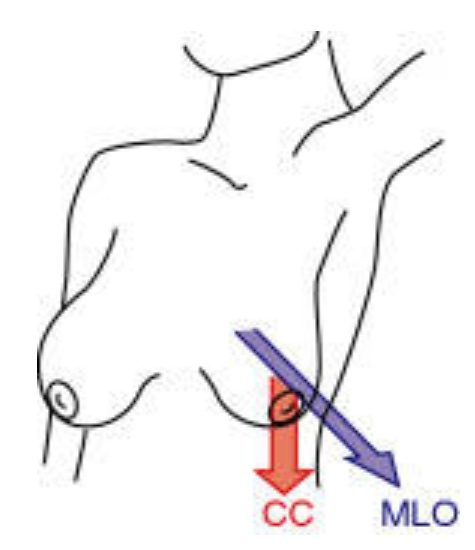 475x550 Mediolateral Oblique View New Medical Terms Mammography Projection