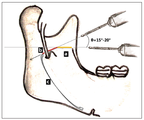 475x394 A Guiding Oblique Osteotomy Cut To Prevent Bad Split In Sagittal