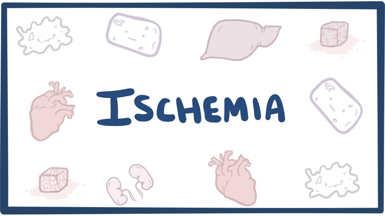 1280x720 Ischemia