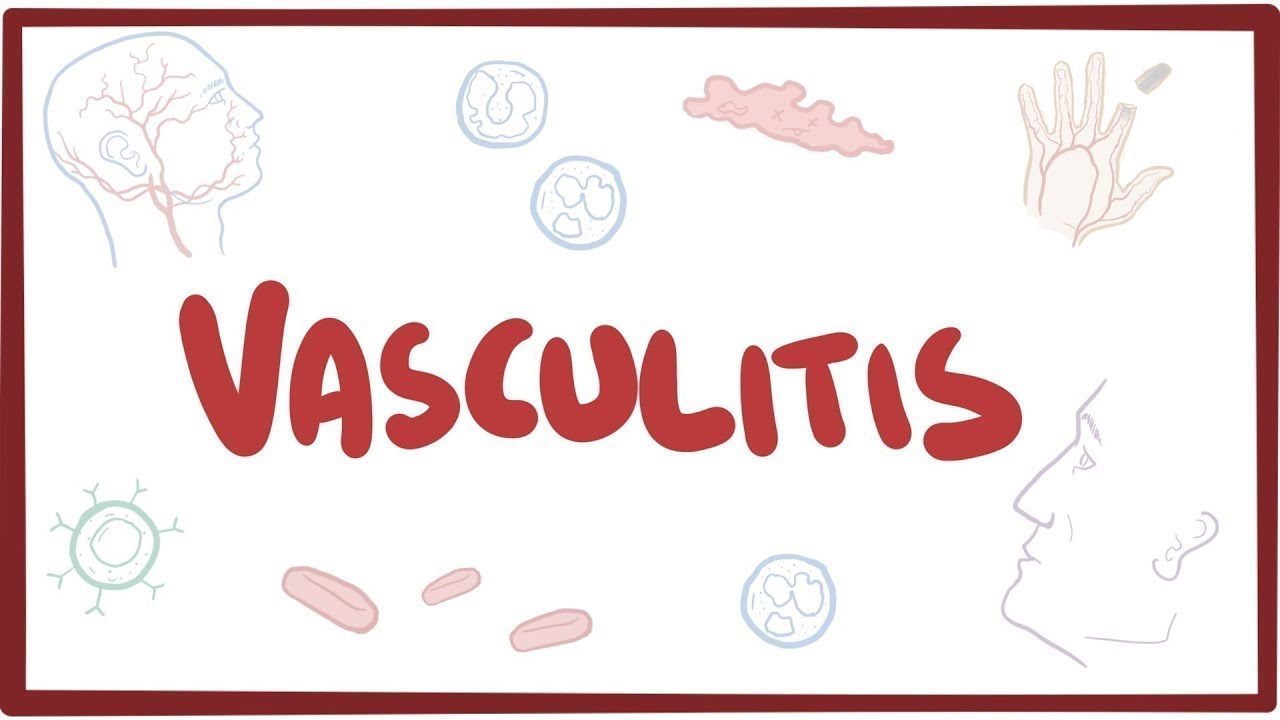 1280x720 Vasculitis