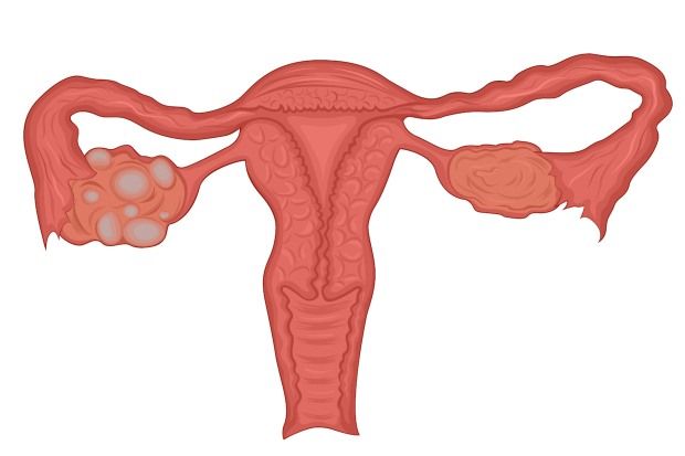 620x413 polycystic ovary syndrome causes and management chemist druggist