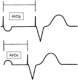 267x273 optimization of atrio ventricular delay in patients with dual