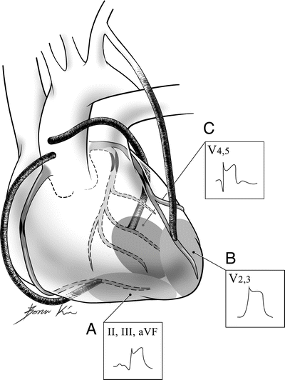 400x532 postoperative care of the cardiac surgical patient springerlink