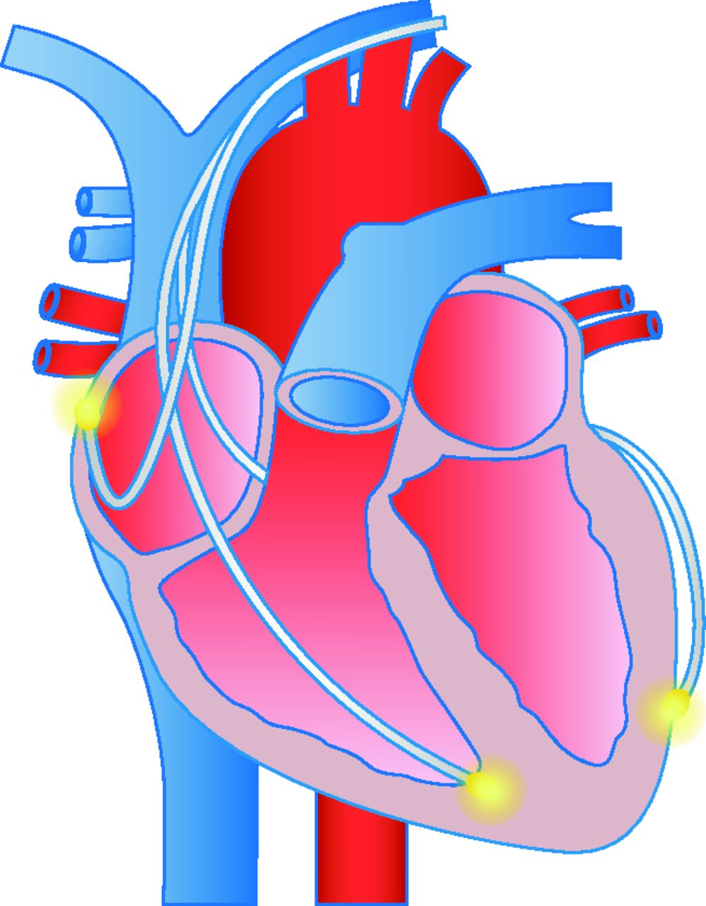 998x1280 Bradyarrhythmias And Pacemakers The Bmj