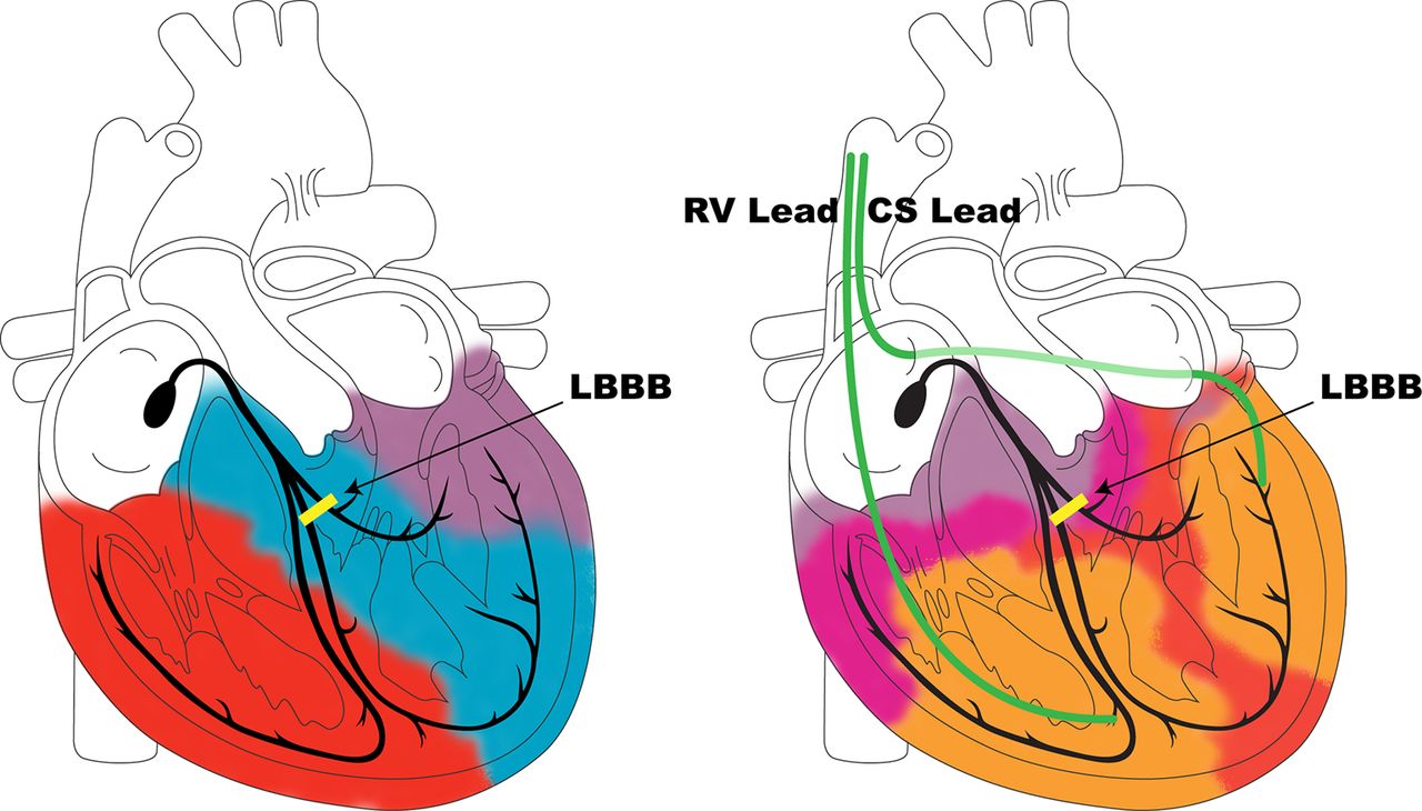1280x730 cardiac resynchronisation therapy current indications, management