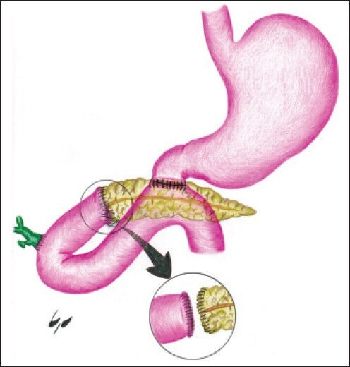 496x520 Pancreas And Adjacent Jejunum Was Debrided And Pancreat Open I