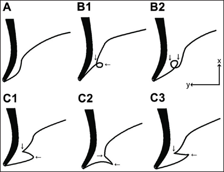 742x569 reversed z shaped anomaly of main pancreatic duct as a cause