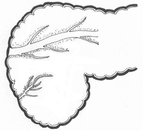 500x457 Bhasin Dk, Et Al Ansa Pancreatica Type Of Ductal Anatomy
