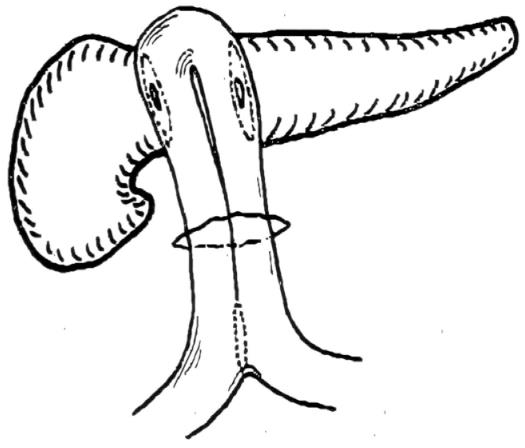525x448 Central Pancreatectomy The Dagradi Serio Iacono Operation
