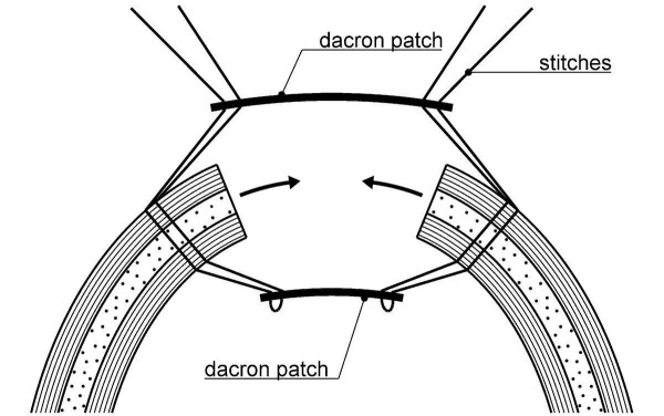 600x376 Drawing Of The Two Dacron Patches During The Closure, For Each