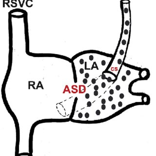 320x320 The Schematic Drawing Shows The Anatomy Of The Coronary Sinus