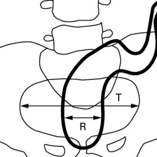 320x320 determination of the rpr the maximal pelvis diameter