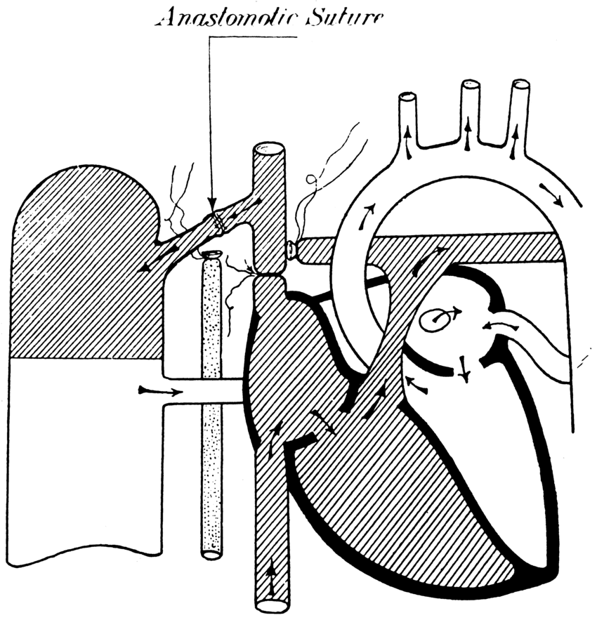 850x883 cavo pulmonary anastomosis via the azygos vein carlon's technique