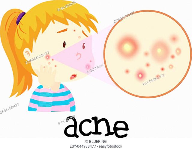 640x501 drawing acne pimple stock photos and images age fotostock
