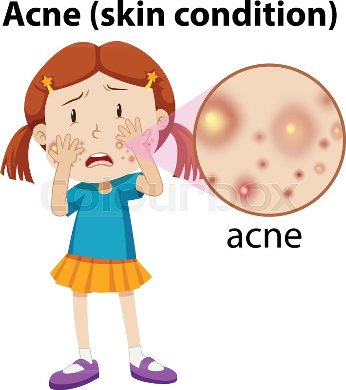710x800 a young girl having acne illustration stock vector colourbox