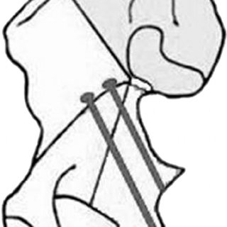 320x320 Schematic Drawing On The Use Of Spring Plates