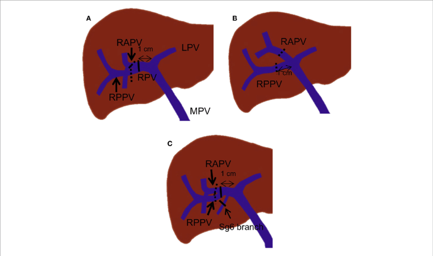 850x503 right pve strategies based on portal vein branching anatomy